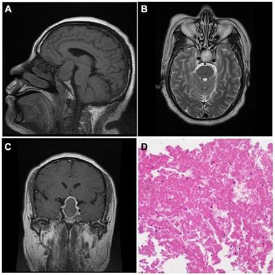 Ischemic Infarction of Pituitary Apoplexy: A Retrospective Study of 46 Cases From a Single Tertiary Center